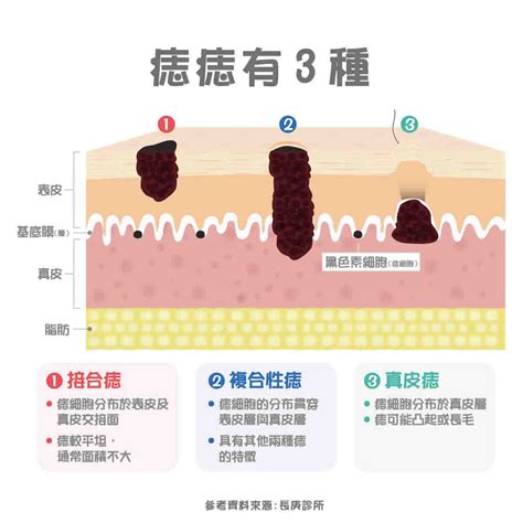 身體痣|痣變大、痣多或長毛會變皮膚癌？認識痣的形成與原因